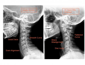 15-yrs-post-whiplash, Dr. Keefe, Natural Health care, pain, Tulsa chiropractor, neck pain, headache,