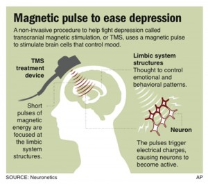 magnetic_pulse_to_be_used_for_depression_8331670164