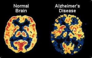 alzheimers-largeDr. Keefe, Keefe Clinic. Tulsa Chiropractor, pain, natural health care.